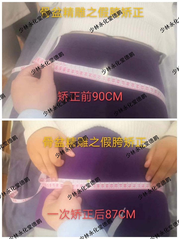 少林永化堂產(chǎn)后項(xiàng)目-骨盆修復(fù)1.jpg